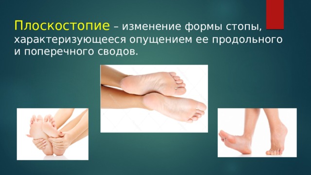Плоскостопие – изменение формы стопы, характеризующееся опущением ее продольного и поперечного сводов. 