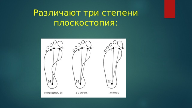 Различают три степени плоскостопия: 