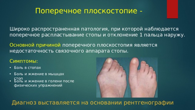 Поперечное плоскостопие - Широко распространенная патология, при которой наблюдается поперечное распластывание стопы и отклонение 1 пальца наружу. Основной причиной поперечного плоскостопия является недостаточность связочного аппарата стопы. Симптомы: Боль в стопах Боль и жжение в мышцах стоп Боль и жжение в голени после физических упражнений Диагноз выставляется на основании рентгенографии 