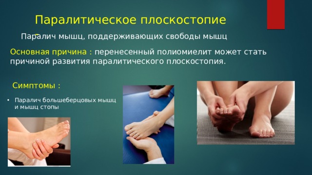 Паралитическое плоскостопие - Паралич мышц, поддерживающих свободы мышц Основная причина : перенесенный полиомиелит может стать причиной развития паралитического плоскостопия. Симптомы : Паралич большеберцовых мышц и мышц стопы 
