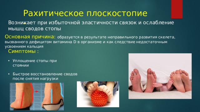 Рахитическое плоскостопие - Возникает при избыточной эластичности связок и ослабление мышц сводов стопы Основная причина: образуется в результате неправильного развития скелета, вызванного дефицитом витамина D в организме и как следствие недостаточным усвоением кальция Симптомы : Уплощение стопы при стоянии Быстрое восстановление сводов после снятия нагрузки 