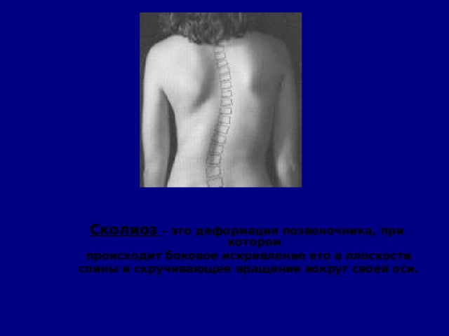  Сколиоз  – это деформация позвоночника, при котором  происходит боковое искривление его в плоскости  спины и скручивающее вращение вокруг своей оси .  