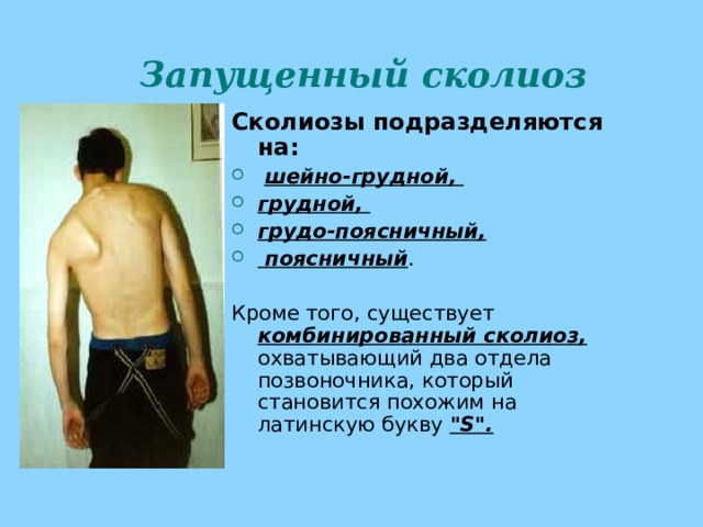 Запущенный сколиоз Сколиозы подразделяются на:  шейно-грудной, грудной, грудо-поясничный,  поясничный .  Кроме того, существует комбинированный сколиоз, охватывающий два отдела позвоночника, который становится похожим на латинскую букву 