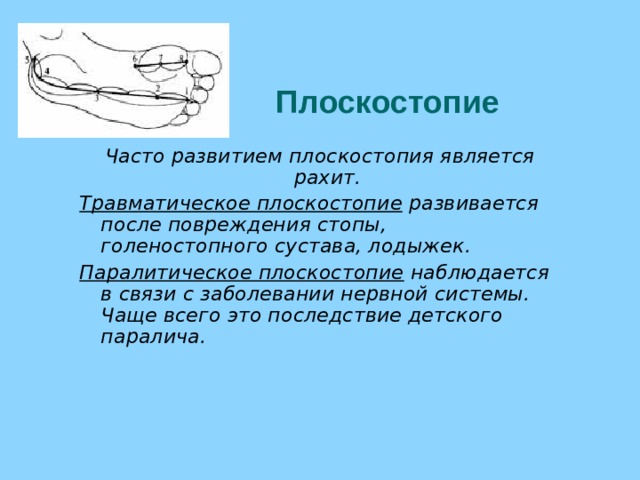 Плоскостопие Часто развитием плоскостопия является рахит. Травматическое плоскостопие развивается после повреждения стопы, голеностопного сустава, лодыжек. Паралитическое плоскостопие наблюдается в связи с заболевании нервной системы. Чаще всего это последствие детского паралича.     