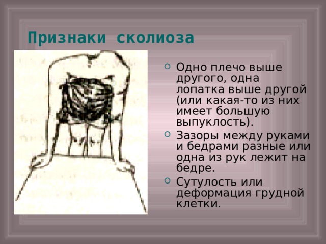 Признаки сколиоза  Одно плечо выше другого, одна лопатка выше другой (или какая-то из них имеет большую выпуклость). Зазоры между руками и бедрами разные или одна из рук лежит на бедре. Сутулость или деформация грудной клетки. 