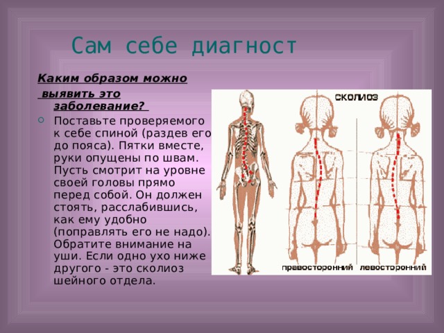 Сам себе диагност Каким образом можно  выявить это заболевание? Поставьте проверяемого к себе спиной (раздев его до пояса). Пятки вместе, руки опущены по швам. Пусть смотрит на уровне своей головы прямо перед собой. Он должен стоять, расслабившись, как ему удобно (поправлять его не надо). Обратите внимание на уши. Если одно ухо ниже другого - это сколиоз шейного отдела. 