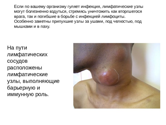 Если по вашему организму гуляет инфекция, лимфатические узлы могут болезненно вздуться, стремясь уничтожить как вторгшегося врага, так и погибшие в борьбе с инфекцией лимфоциты. Особенно заметны припухшие узлы за ушами, под челюстью, под мышками и в паху. На пути лимфатических сосудов расположены лимфатические узлы, выполняющие барьерную и иммунную роль. 