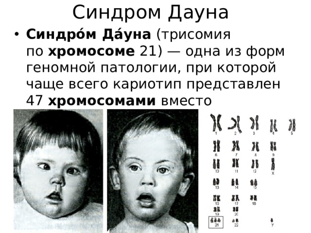 Синдром Дауна Синдро́м Да́уна  (трисомия по  хромосоме  21) — одна из форм геномной патологии, при которой чаще всего кариотип представлен 47  хромосомами  вместо нормальных 46 