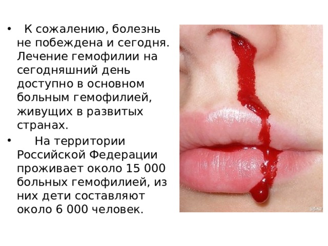  К сожалению, болезнь не побеждена и сегодня. Лечение гемофилии на сегодняшний день доступно в основном больным гемофилией, живущих в развитых странах.  На территории Российской Федерации проживает около 15 000 больных гемофилией, из них дети составляют около 6 000 человек. 