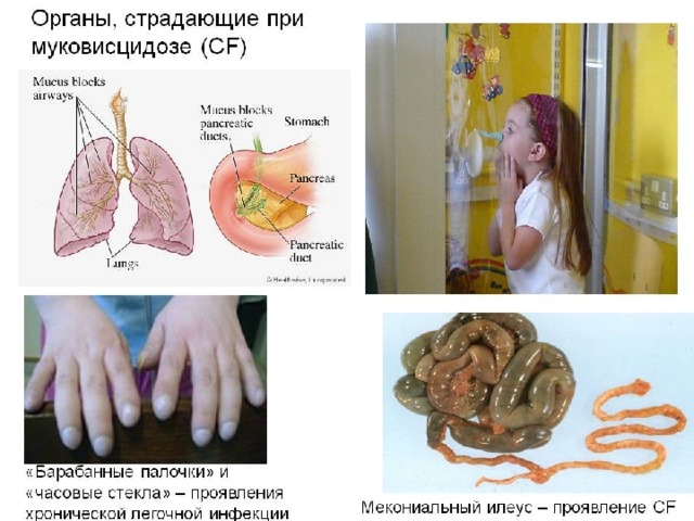 Муковисцидоз 