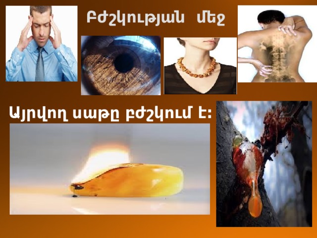 Բժշկության մեջ Այրվող սաթը բժշկում է: 