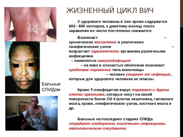 Жизненный цикл ВИЧ  У здорового человека в 1мл крови содержится 600 - 800 хелперов, к девятому месяцу после заражения их число постепенно снижается  Возникает: – хроническое воспаление и увеличение лимфатических узлов – возрастает зараженность организма различными инфекциями – появляется иммунодефицит – на коже и слизистых оболочках возникает грибковое поражение типа молочницы – человек умирает от инфекций , которые для здорового человека не опасны   Кроме Т-лимфоцитов вирус поражает и другие клетки организма , которые несут на своей поверхности белки CD 4 (клетки кишечника, головного мозга, крови, лимфатических узлов, костного мозга и др.   Больные на последних стадиях СПИДа страдают слабоумием, кишечными инфекциями, патологическим похуданием .  Больные СПИДом 