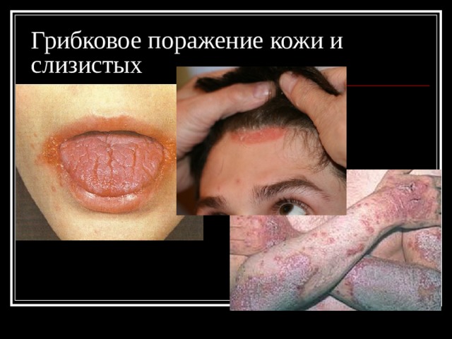 Грибковое поражение кожи и слизистых 