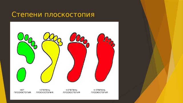 Степени плоскостопия 
