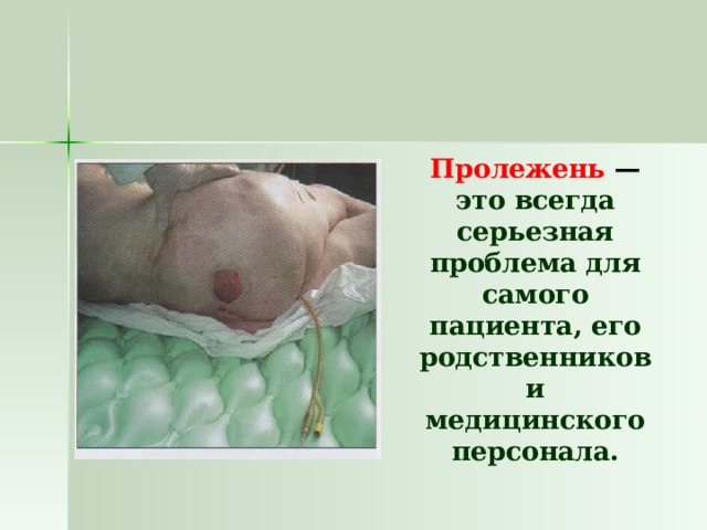  Пролежень — это всегда серьезная проблема для самого пациента, его родственников и медицинского персонала. 