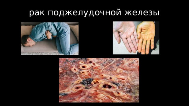 рак поджелудочной железы 