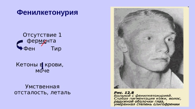 Фенилкетонурия  Отсутствие 1 фермента  Фен Тир  Кетоны в крови, моче  Умственная отсталость, леталь 