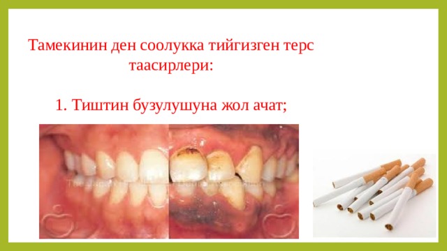 Тамекинин ден соолукка тийгизген терс таасирлери: 1. Тиштин бузулушуна жол ачат; 