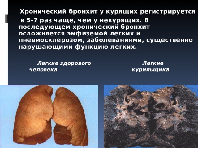  Хронический бронхит у курящих регистрируется  в 5-7 раз чаще, чем у некурящих. В последующем хронический бронхит осложняется эмфиземой легких и пневмосклерозом, заболеваниями, существенно нарушающими функцию легких.     Легкие здорового Легкие  человека курильщика  
