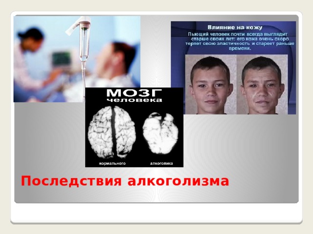 Последствия алкоголизма   