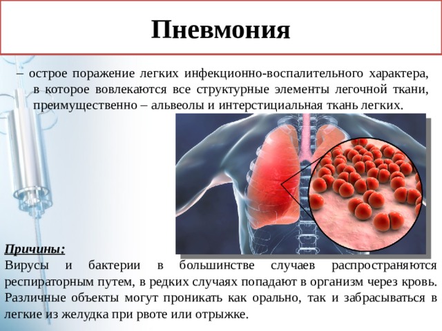 Пневмония – острое поражение легких инфекционно-воспалительного характера, в которое вовлекаются все структурные элементы легочной ткани, преимущественно – альвеолы и интерстициальная ткань легких. Причины: Вирусы и бактерии в большинстве случаев распространяются респираторным путем, в редких случаях попадают в организм через кровь. Различные объекты могут проникать как орально, так и забрасываться в легкие из желудка при рвоте или отрыжке. 