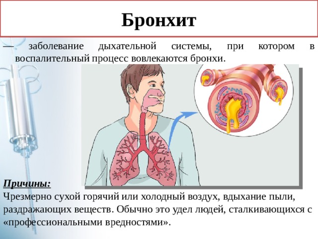 Бронхит — заболевание дыхательной системы, при котором в воспалительный процесс вовлекаются бронхи. Причины: Чрезмерно сухой горячий или холодный воздух, вдыхание пыли, раздражающих веществ. Обычно это удел людей, сталкивающихся с «профессиональными вредностями». 