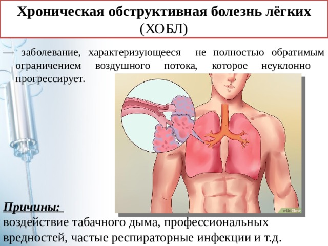 Хроническая  обструктивная  болезнь  лёгких (ХОБЛ) — заболевание, характеризующееся не полностью обратимым ограничением воздушного потока, которое неуклонно прогрессирует. Причины: воздействие табачного дыма, профессиональных вредностей, частые респираторные инфекции и т.д. 