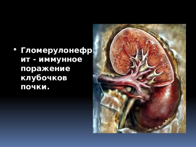 Гломерулонефрит - иммунное поражение клубочков почки. 