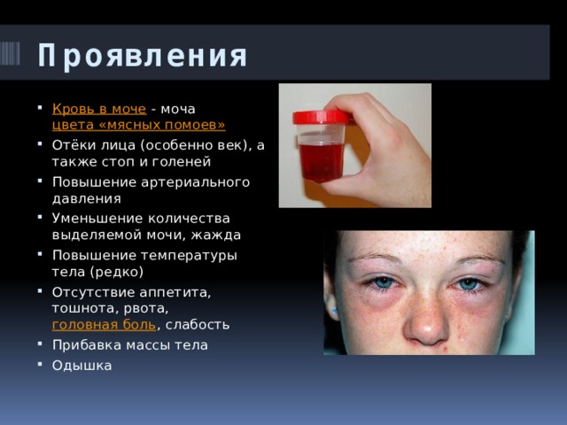 Проявления  Кровь в моче  - моча  цвета «мясных помоев» Отёки лица (особенно век), а также стоп и голеней Повышение артериального давления Уменьшение количества выделяемой мочи, жажда Повышение температуры тела (редко) Отсутствие аппетита, тошнота, рвота,  головная боль , слабость Прибавка массы тела Одышка 