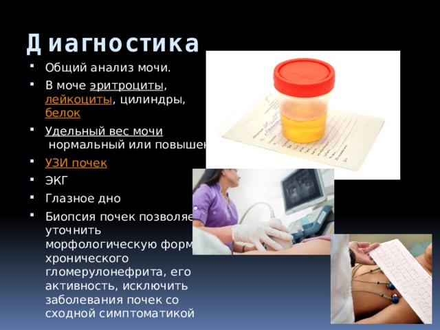 Диагностика Общий анализ мочи. В моче  эритроциты ,  лейкоциты , цилиндры,  белок Удельный вес мочи  нормальный или повышен УЗИ почек ЭКГ Глазное дно Биопсия почек позволяет уточнить морфологическую форму хронического гломерулонефрита, его активность, исключить заболевания почек со сходной симптоматикой  