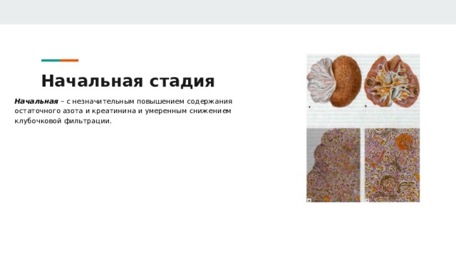 Начальная стадия Начальная – с незначительным повышением содержания остаточного азота и креатинина и умеренным снижением клубочковой фильтрации. 