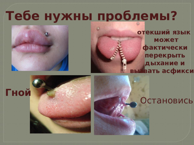 Тебе нужны проблемы? отекший язык  может фактически перекрыть дыхание и вызвать асфиксию Гной Остановись ! 