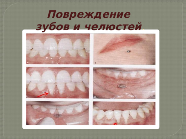 Повреждение  зубов и челюстей . 