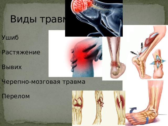 Виды травм Ушиб   Растяжение   Вывих   Черепно-мозговая травма   Перелом   