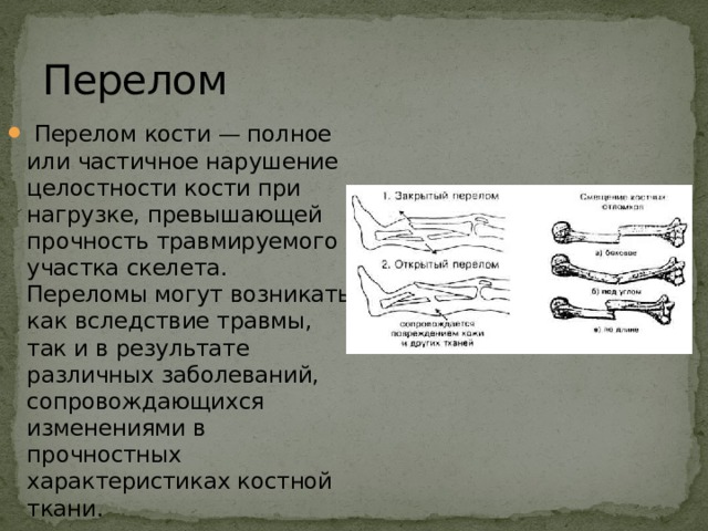 Перелом  Перелом кости — полное или частичное нарушение целостности кости при нагрузке, превышающей прочность травмируемого участка скелета. Переломы могут возникать как вследствие травмы, так и в результате различных заболеваний, сопровождающихся изменениями в прочностных характеристиках костной ткани. 