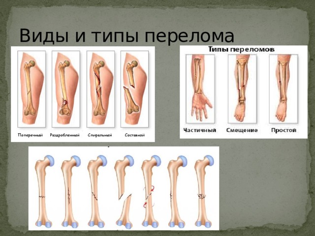 Виды и типы перелома 