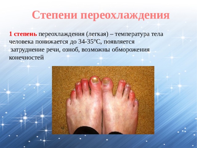 Степени переохлаждения  1 степень переохлаждения (легкая) – температура тела человека понижается до 34-35°C, появляется  затруднение речи, озноб, возможны обморожения конечностей 