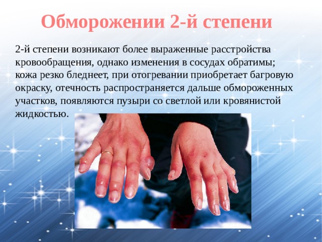 Обморожении 2-й степени 2-й степени возникают более выраженные расстройства кровообращения, однако изменения в сосудах обратимы; кожа резко бледнеет, при отогревании приобретает багровую окраску, отечность распространяется дальше обмороженных участков, появляются пузыри со светлой или кровянистой жидкостью. 