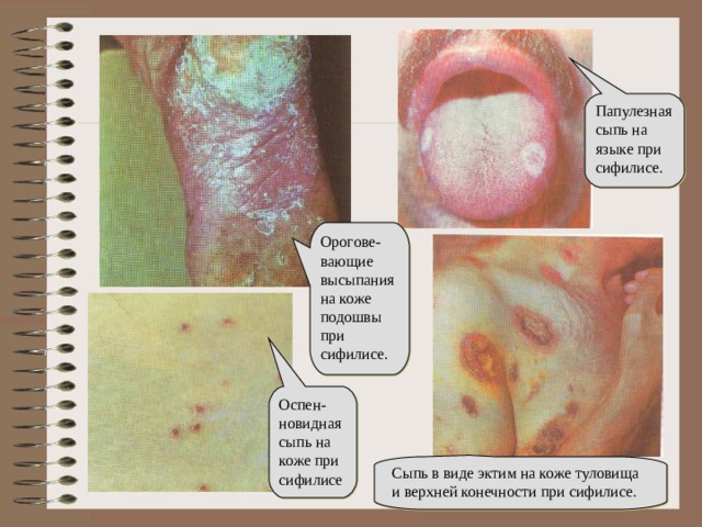 Папулезная сыпь на языке при сифилисе. Орогове-вающие высыпания на коже подошвы при сифилисе. Оспен-новидная сыпь на коже при сифилисе Сыпь в виде эктим на коже туловища и верхней конечности при сифилисе.
