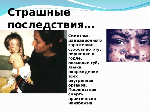 Страшные последствия… Симптомы радиационного заражения: сухость во рту, першение в горле, онемение губ, языка, повреждение всех внутренних органов. Последствия: смерть практически неизбежна. 