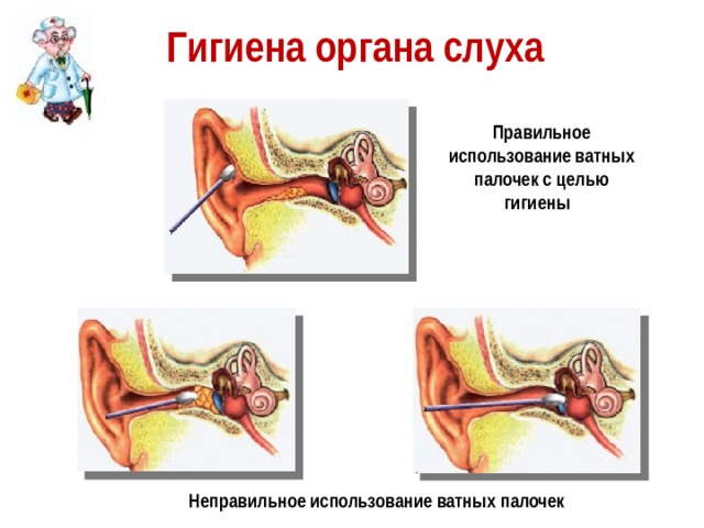 Гигиена органа слуха Правильное использование ватных палочек с целью гигиены Неправильное использование ватных палочек 