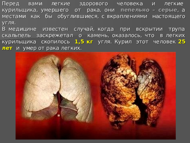 Перед вами легкие здорового человека и легкие курильщика, умершего от рака, они пепельно – серые , а местами как бы обуглившиеся, с вкраплениями настоящего угля.  В медицине известен случай, когда при вскрытии трупа скальпель заскрежетал о камень, оказалось, что в легких курильщика скопилось 1,5 кг угля. Курил этот человек 25 лет и умер от рака легких.  