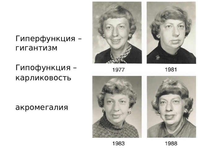 Гиперфункция – гигантизм Гипофункция – карликовость акромегалия 