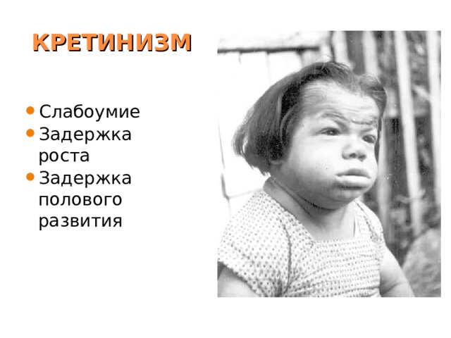 КРЕТИНИЗМ Слабоумие Задержка роста Задержка полового развития   