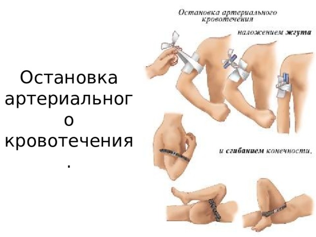 Остановка артериального кровотечения. При артериальном кровотечении сосуд сдавливают выше места его повреждения, а при кровотечении из вены - ниже раны. Для этого нужно знать схему магистральных артериальных сосудов и места их пальцевого прижатия  