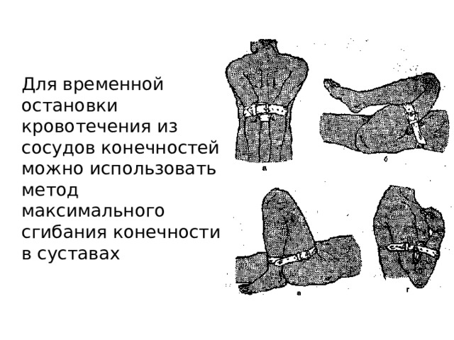  Для временной остановки кровотечения из сосудов конечностей можно использовать метод максимального сгибания конечности в суставах Для временной остановки кровотечения из сосудов конечностей можно использовать метод максимального сгибания конечности в суставах (рис. 4). При кровотечении из сосудов плеча руку заводят за спину и фиксируют ее повязкой. Если кровоточат сосуды предплечья, руку сгибают в локтевом суставе. При кровотечении из ран голени или стопы ногу сгибают максимально в коленном суставе и, придав конечности такое положение, ее надежно прибинтовывают  