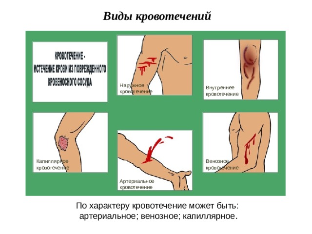 Виды кровотечений Наружное кровотечение Внутреннее кровотечение Венозное кровотечение Капиллярное кровотечение Артериальное кровотечение По характеру кровотечение может быть: артериальное; венозное; капиллярное. 