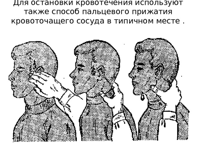 Для остановки кровотечения используют также способ пальцевого прижатия кровоточащего сосуда в типичном месте .   Для остановки кровотечения используют также способ пальцевого прижатия кровоточащего сосуда в типичном месте . Лучше всего, если удается прижать этот сосуд к кости.  