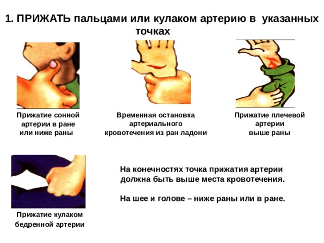 1. ПРИЖАТЬ пальцами или кулаком артерию в указанных точках  Прижатие плечевой Временная остановка артериального  артерии кровотечения из ран ладони выше раны Прижатие сонной артерии в ране или ниже раны На конечностях точка прижатия артерии должна быть выше места кровотечения.  На шее и голове – ниже раны или в ране. Прижатие кулаком  бедренной артерии  