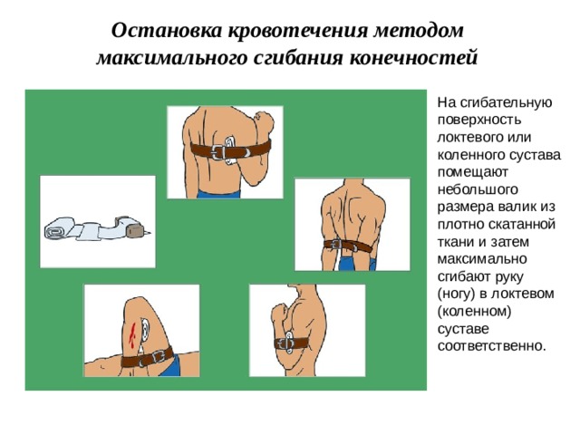 Остановка кровотечения методом максимального сгибания конечностей На сгибательную поверхность локтевого или коленного сустава помещают небольшого размера валик из плотно скатанной ткани и затем максимально сгибают руку (ногу) в локтевом (коленном) суставе соответственно. 